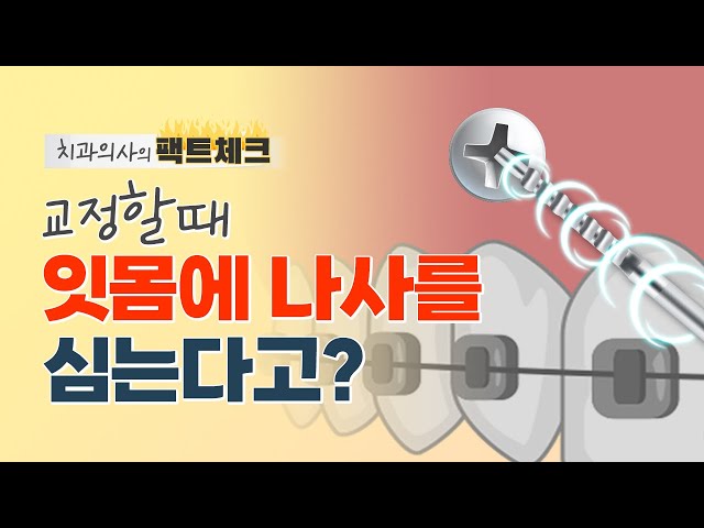 교정용 미니스크류 심는 이유👀 | 미니스크류, 잇몸 나사
