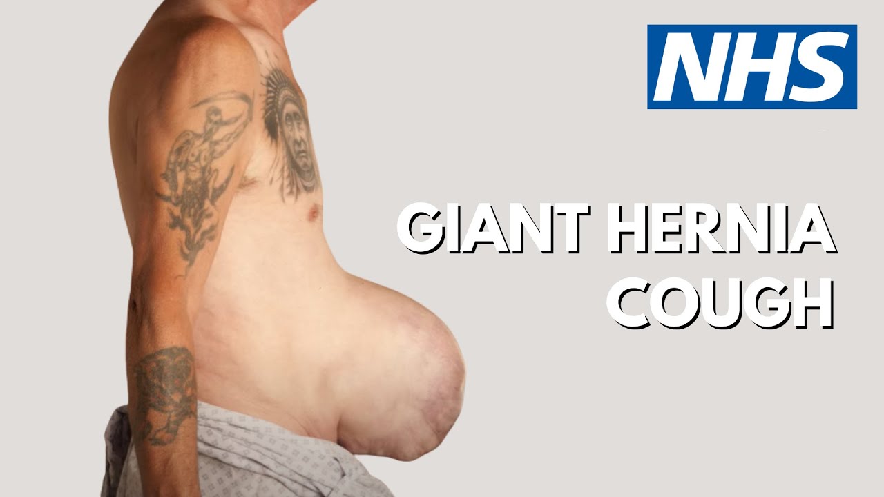 Coughing with a giant hernia | UHL NHS Trust