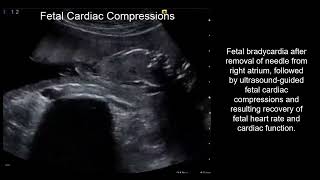 Management of fetal cardiac resuscitation during fetal cardiac intervention
