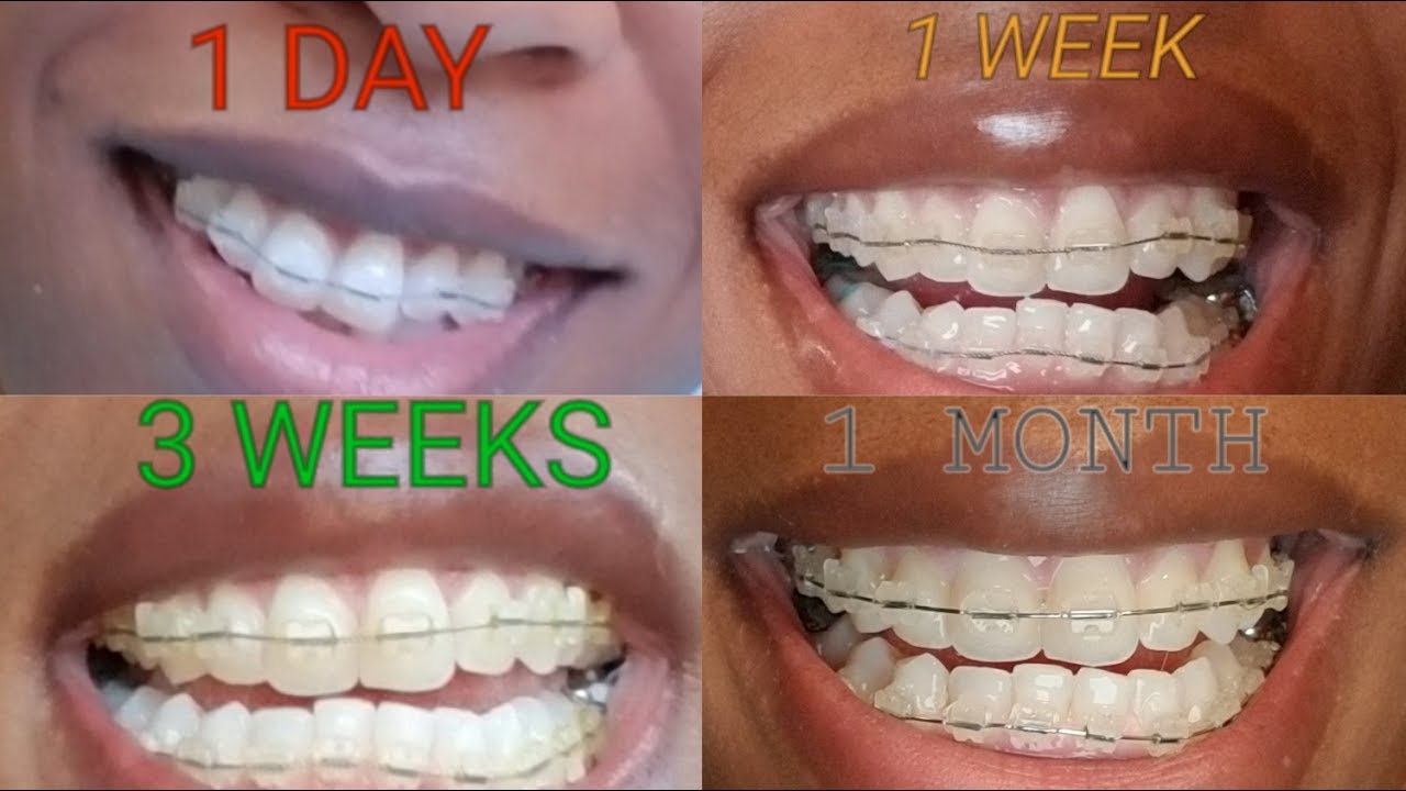 Braces results after 1 month