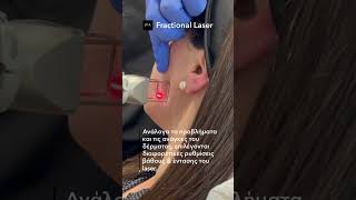 Fractional Laser