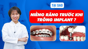 Tại Sao Phải Niềng Răng Mới Được Trồng Implant? | Nam Bùi Vinalign