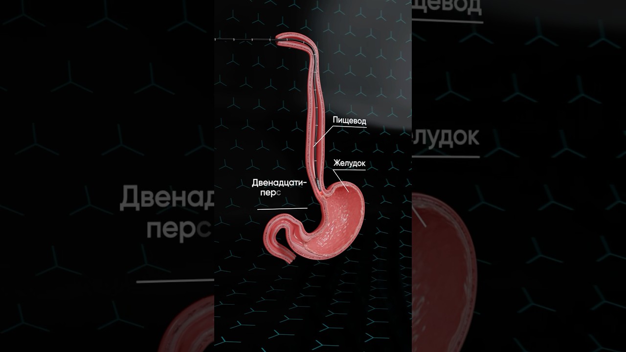 Гастроскопия. ФГДС. Диагностика во сне (под седацией) #медицина #диагностика #врач #эндоскопия