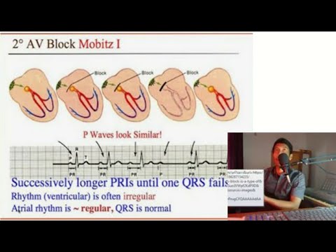Video: Perbedaan Antara Blok Jantung Tingkat Ke-1 Dan Ke-3