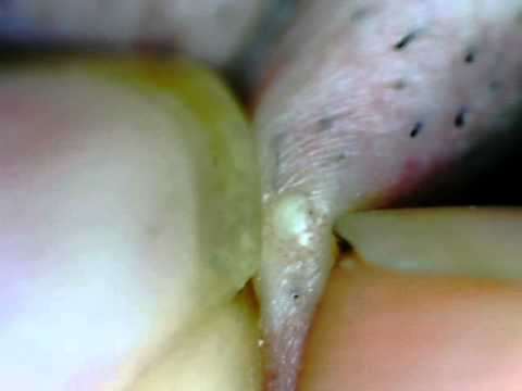 Beard Pimple Pop - YouTube Beard Pimple Pop - YouTube