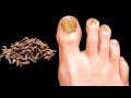 Entfernt Nagelpilz sofort, wie ein Radiergummi! Das beste Mittel! Wirksam gegen Nagelpilz 100 %