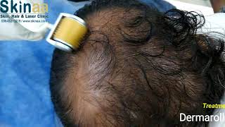 Derma Roller Therapy For Hair Re-Growth In Jaipur Skinaa Clinic