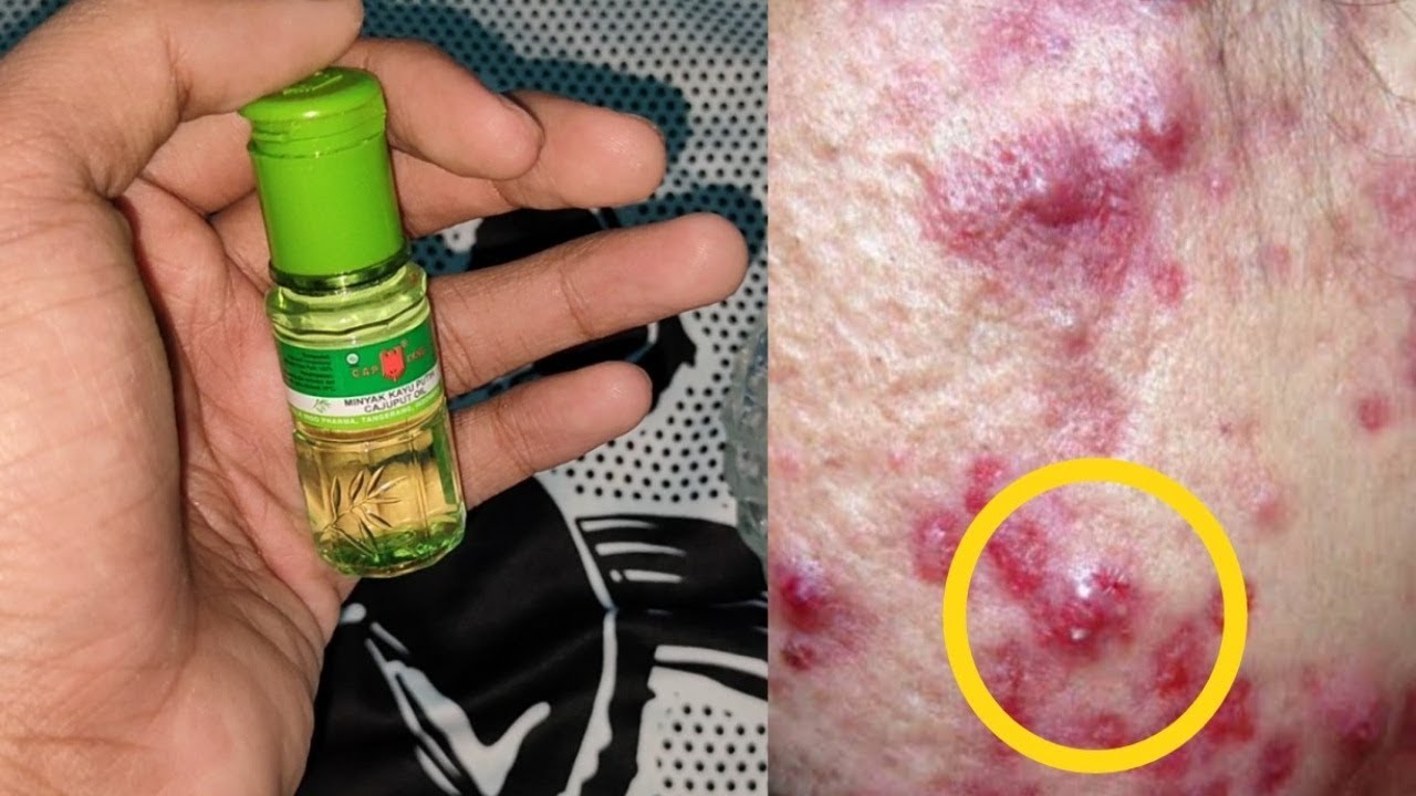 Tambahkan ini saja!! Jerawat diwajah hilang seketika, Cara