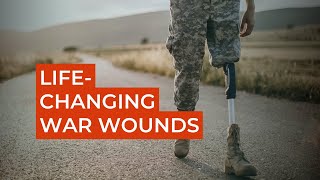 Evolution of Care for Combatants with life-changing Injuries. Ukraine in Flames #503