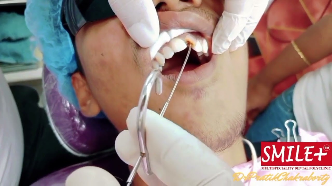 🌹 MINERAL TRIOXIDE AGGREGATE APPLICATION 🌹