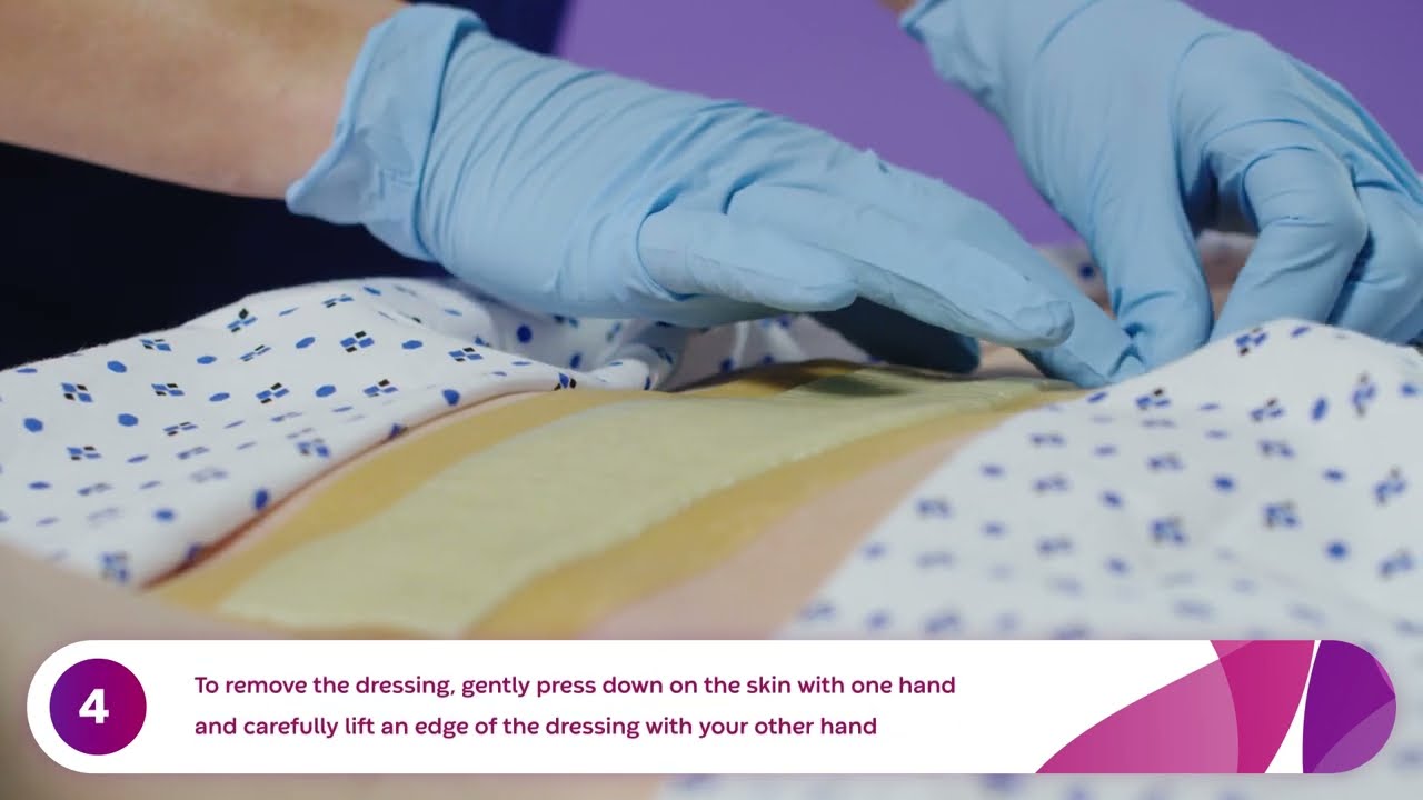 How to Apply and Remove Aquacel Ag Surgical Dressings (Sternum) How to Apply and Remove Aquacel Ag Surgical Dressings (Sternum)