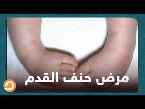 ما هو مرض حنف القدم تعرف عليه من خلال برنامج طبيب اونلاين 