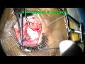 Congenital Brown syndrome (superior oblique Hang-Back Recession)