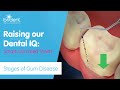 Stages of Gum Disease - More detail from Brident Dental