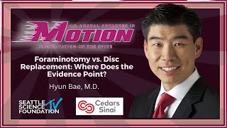 Foraminotomy vs Disc Replacement : Where Does the Evidence Point     Hyun Bae, M.D.