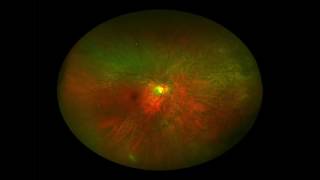 Eye testing in the Deep and Frequent Phenotyping study explained.