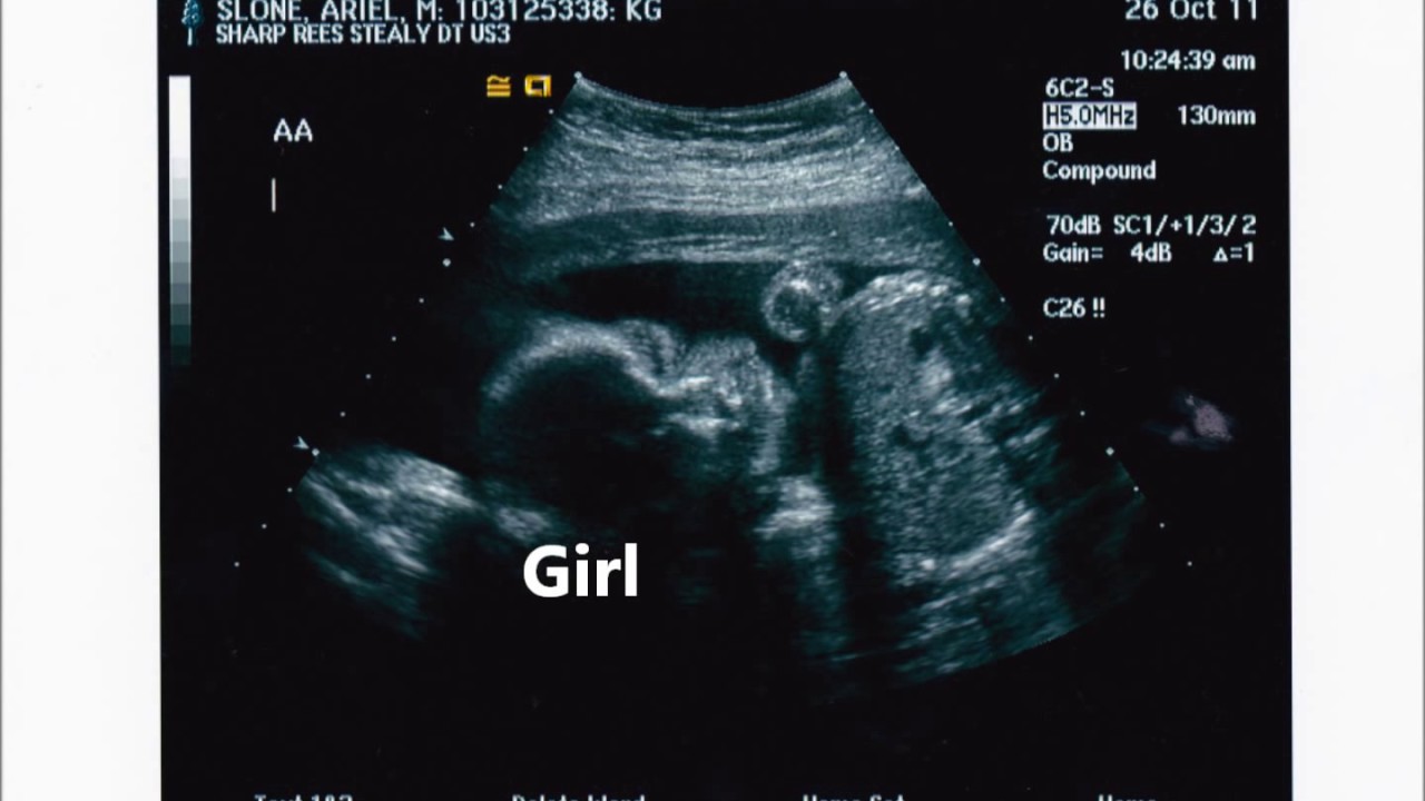 Twin Pregnancy Time Lapse