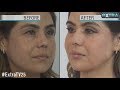 How to Get a Quick Face-Lift Without Surgery