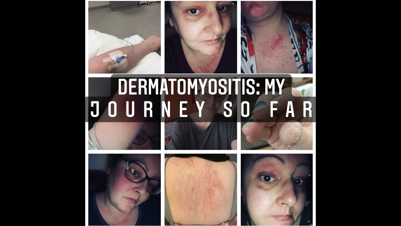 DERMATOMYOSITIS: My Journey So Far