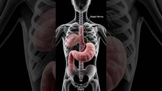 Hiatal Hernia Explained in 3D | Digestive System Animation