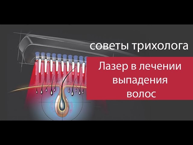 Лазер в лечении выпадения волос