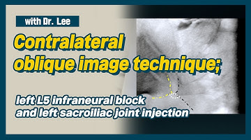 Learn contralateral oblique image C-arm anatomy:  SIJ and infraneural transforaminal injection