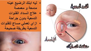 علاج انسداد القنوات الدمعية بدون جراحة ليه ابنك الرضيع عينه مدمعة و معمصة