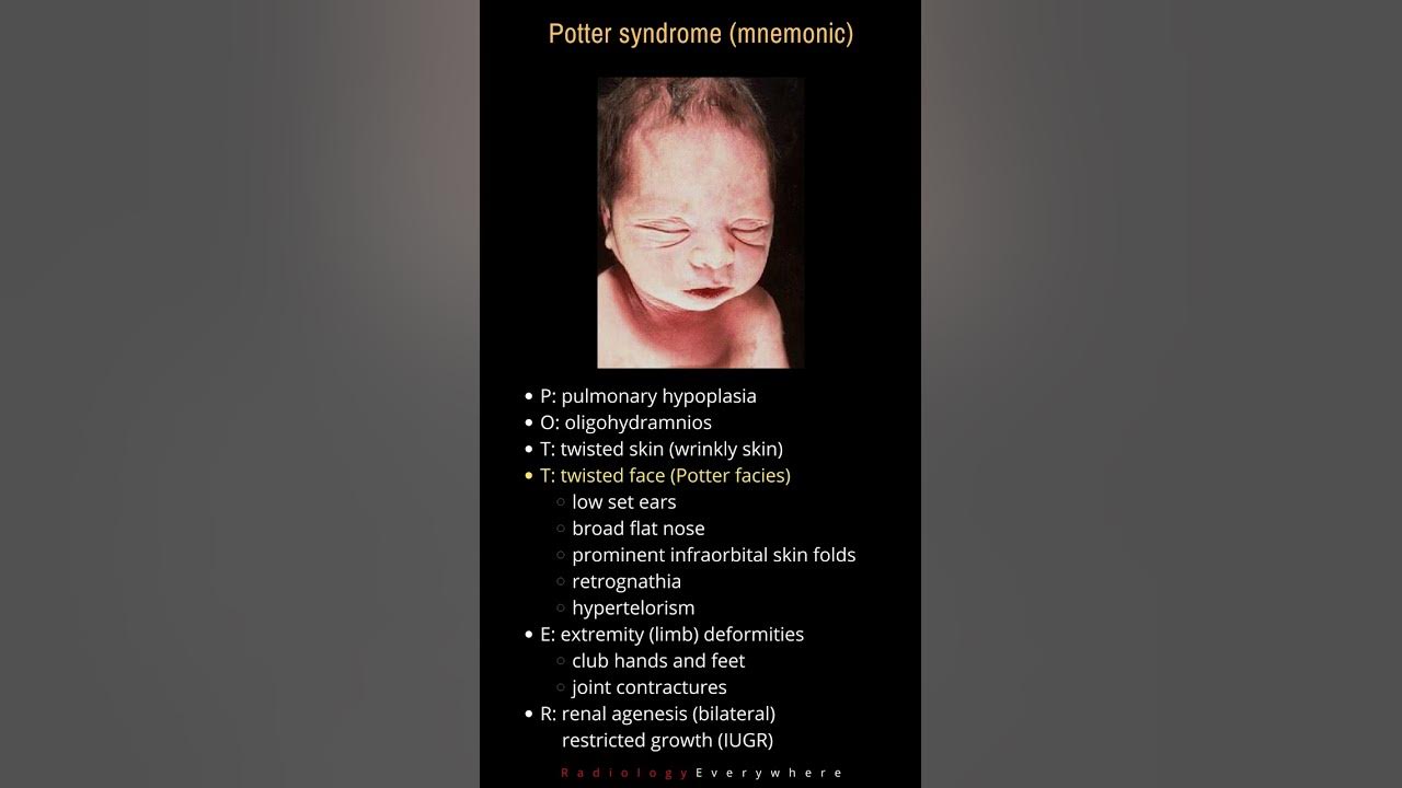 Potter syndrome mnemonic POTTER Radiology tutorials B/L renal