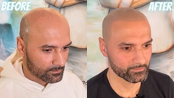 INSIDE LOOK: Crazy Scalp Micropigmentation Result