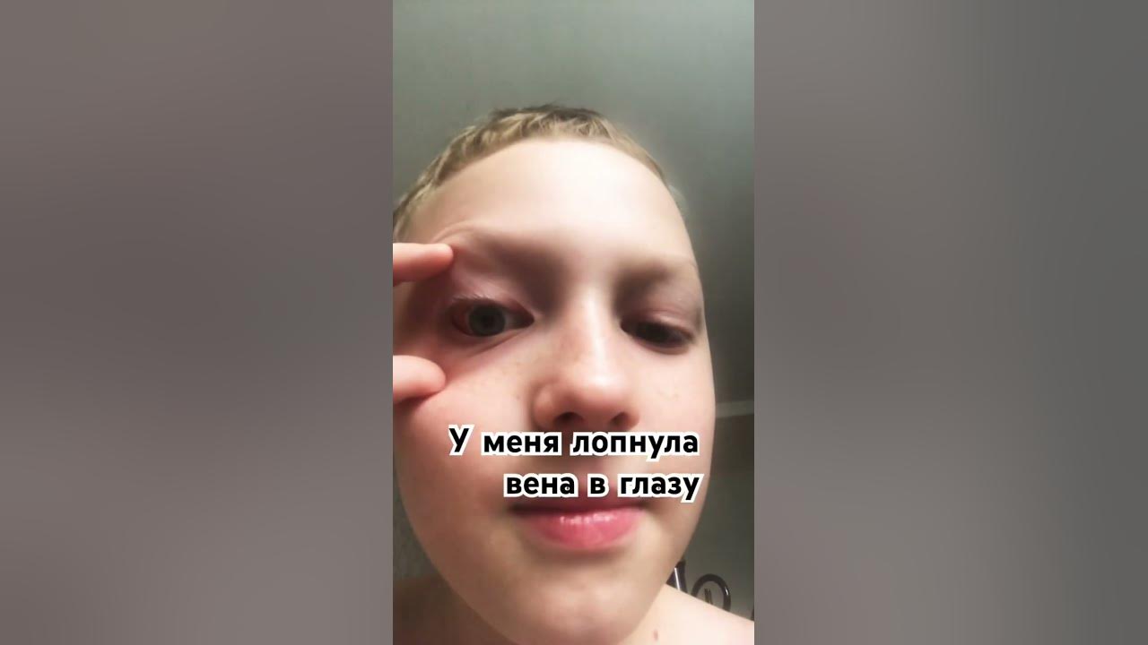 Лопнула вена в глазу - YouTube