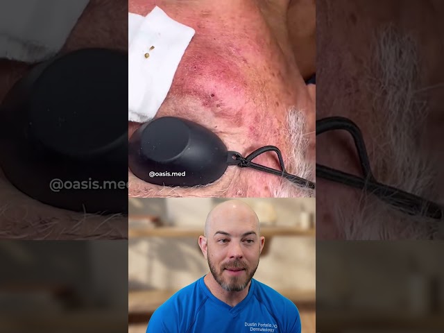 Understanding Favre-Racouchot: Sun Damage and Persistent Blackheads
