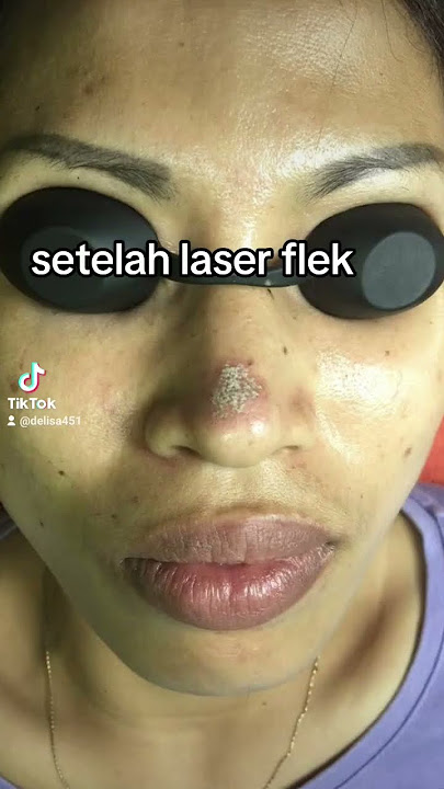 LASER FLEK UNTUK FLEK HITAM DI WAJAH