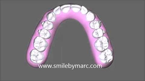 Simulation of orthodontic tooth movement