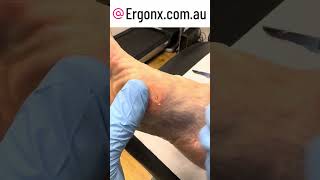 Callus Removal Reveals A Small Wart On The Foot Of A Patient