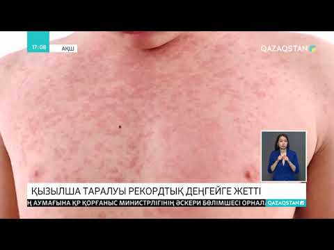 АҚШ-та қызылша ауруының таралуы рекордтық көрсеткішке жетті