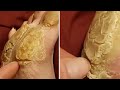 Removing Extremely Hard Foot Callus 🦶 The right way to remove foot callus FULL TREATMENT #11