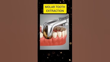 Molar tooth extraction 3D Animation video .. #dentist #dental #dentalcare #dentistry #shorts #teeth