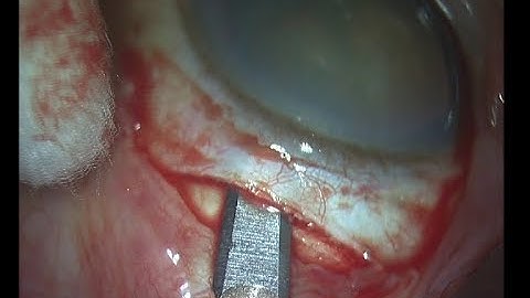 MSICS in Soft Cataract Soosan Jacob with audio 2 12