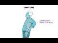 Ankylosing spondylitis (Year of the Zebra 2024)
