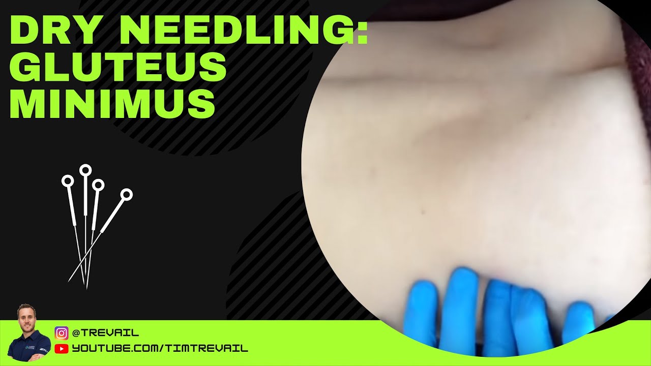 Dry Needling Gluteus Minimus YouTube