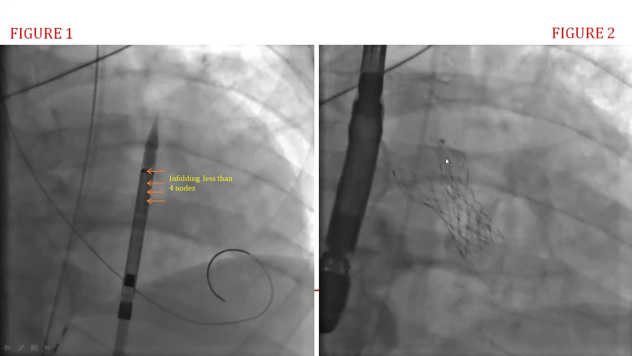 Incomplete Expansion of a Self-Expanding TAVR Device Leading to Hemodynamic collapse