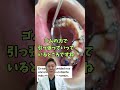 内側に入った歯を引っ張っていっているところですね🤔#歯列矯正 #dentist #矯正歯科 #歯 #インビザライン #歯医者 #蒲田 #矯正