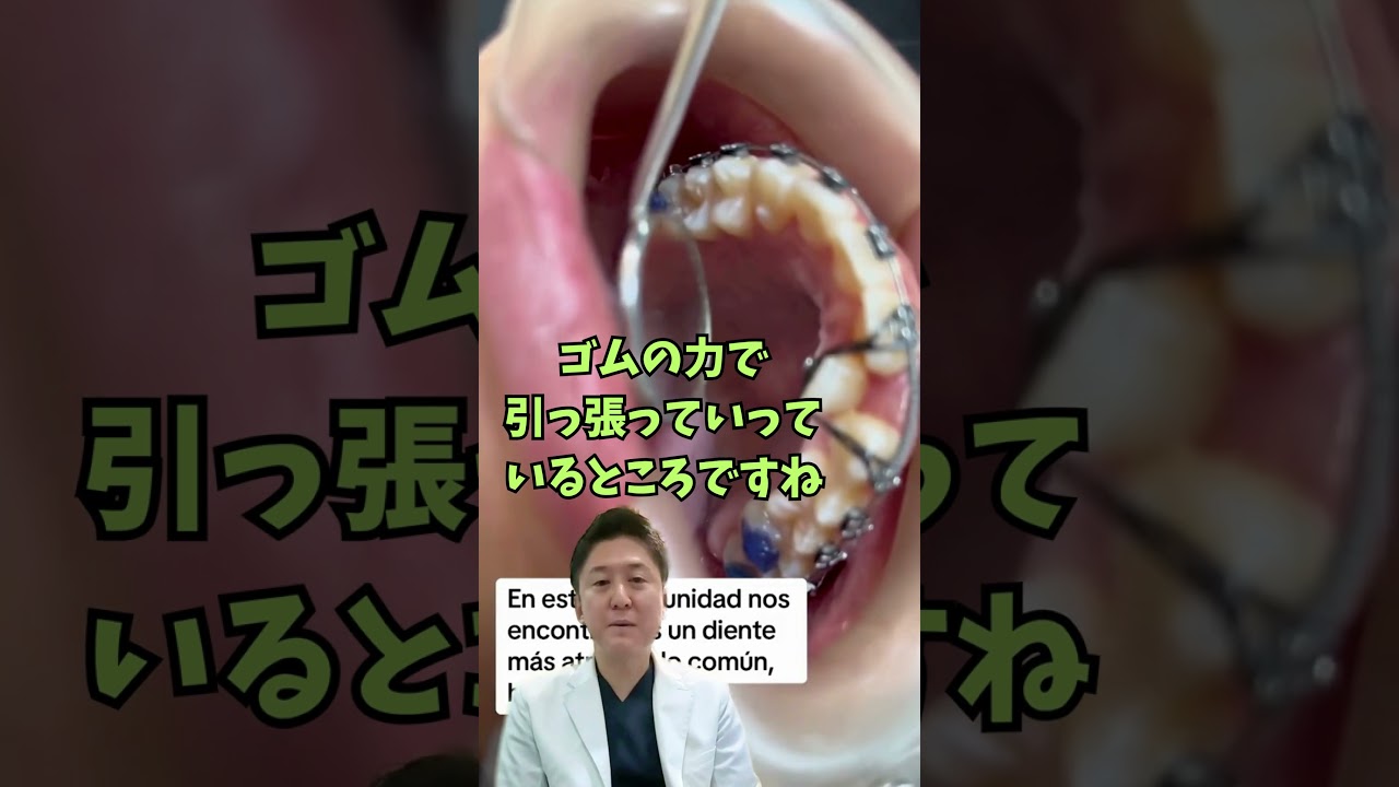 内側に入った歯を引っ張っていっているところですね🤔#歯列矯正 #dentist #矯正歯科 #歯 #インビザライン #歯医者 #蒲田 #矯正