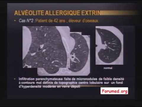 Imagerie des pneumopathies et Fibrose Pulmonaire