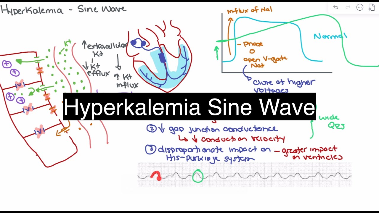 Hyperkalemia Explained: Pathophysiology of Sine Waves