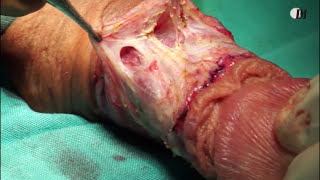 Incurvación Del Pene, Tratamiento Quirúrgico Peyronie
