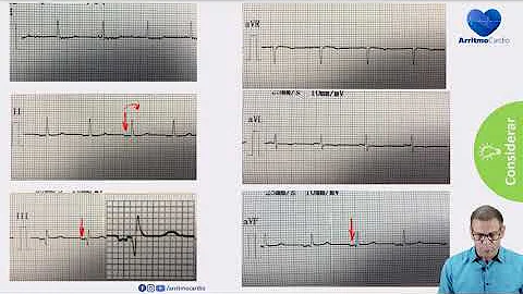 O que é a onda delta no ECG?