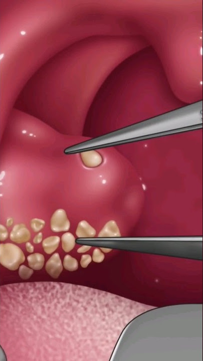 Tonsil Stone Treatment @smilebam #shortsfeed #viral #asmr #relaxingasmr #satisfying#relaxing#souls