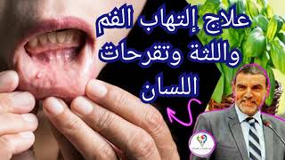 الدكتور محمد الفايد|| علاج إلتهاب وتقرحات الفم واللثة واللسان والأسنان بمادة بسيطة موجودة في كل بيت