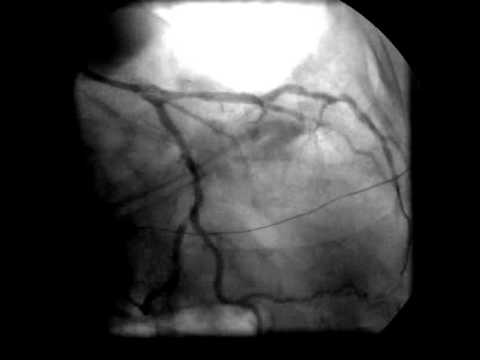 Βίντεο: Είναι το stenting χειρουργική επέμβαση;